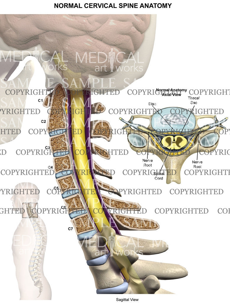 Spinal surgery - cervical - series—Indications: MedlinePlus Medical  Encyclopedia