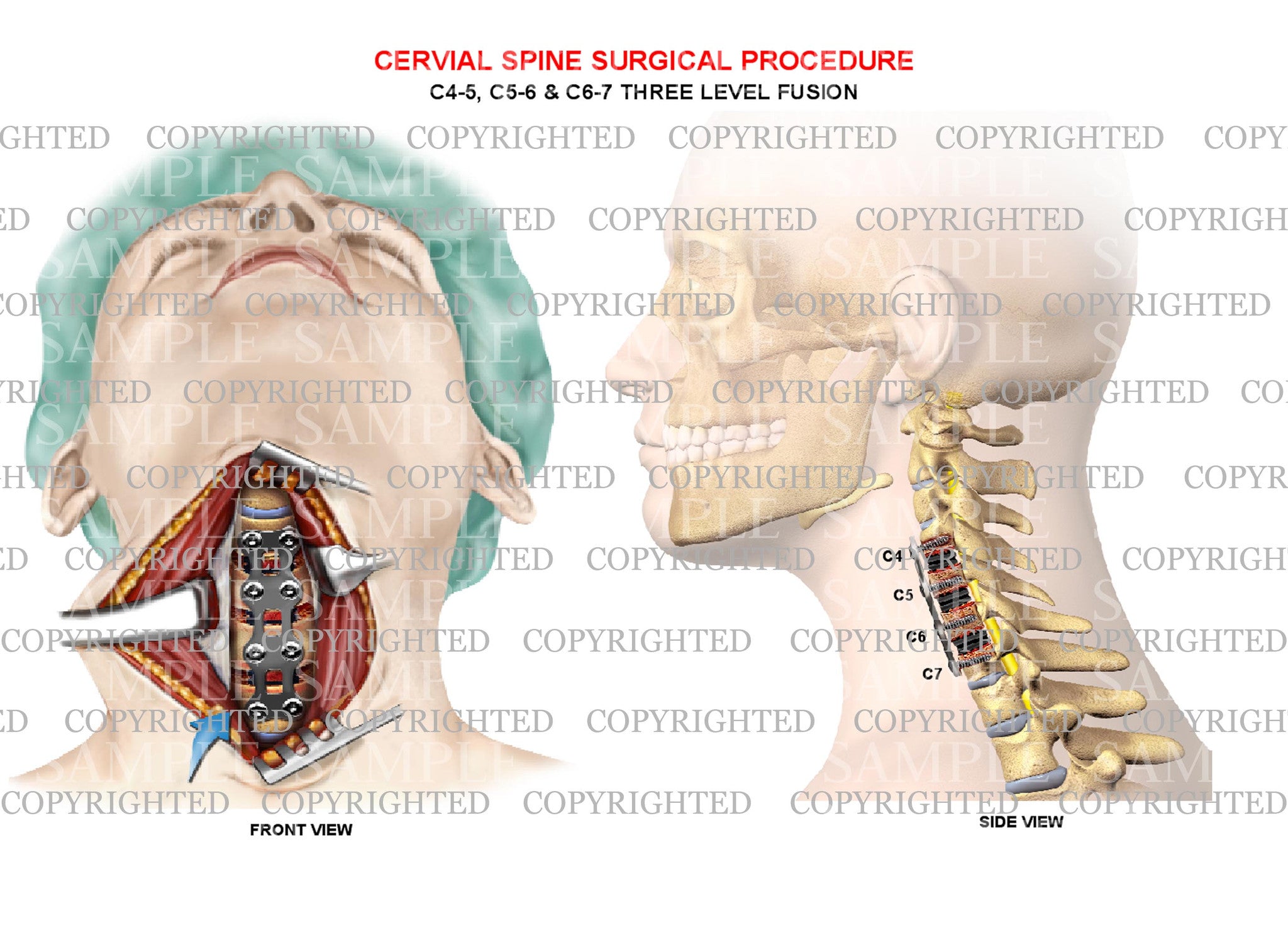 4 level - C3-C7 cervical spine decompression surgical procedure – Medical  Art Works