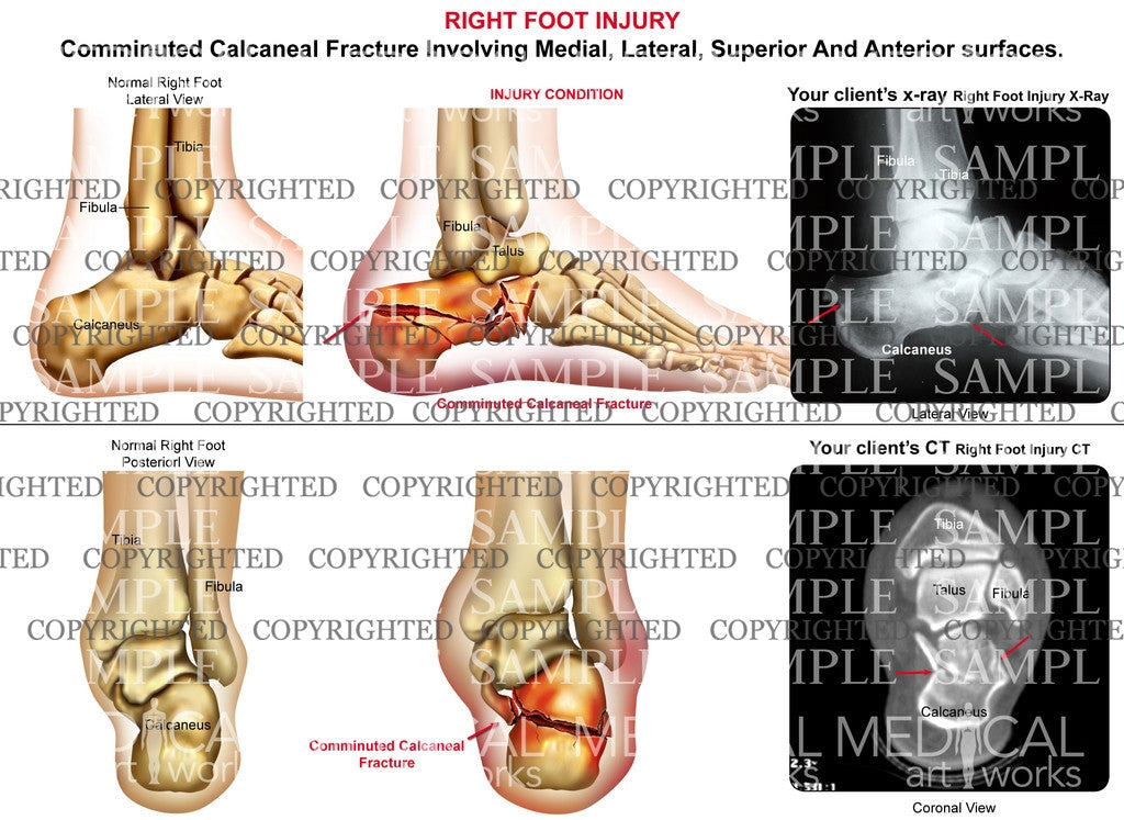 anterior calcaneus fracture