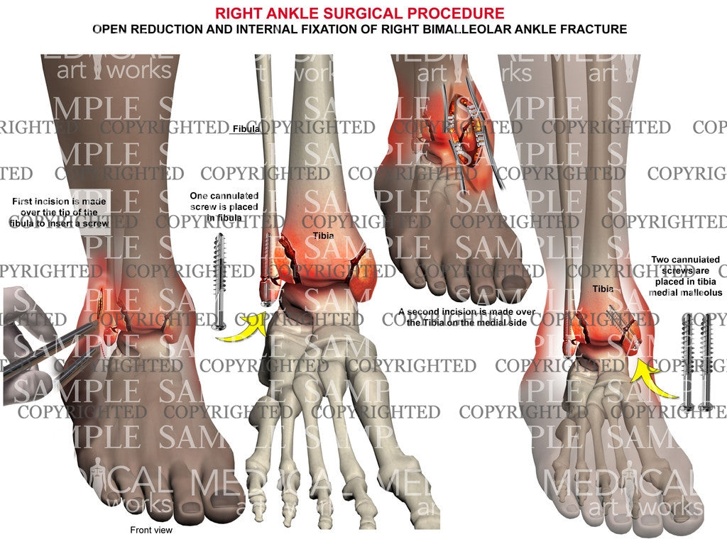 Right bimalleolar fracture & screw fixation – Medical Art Works