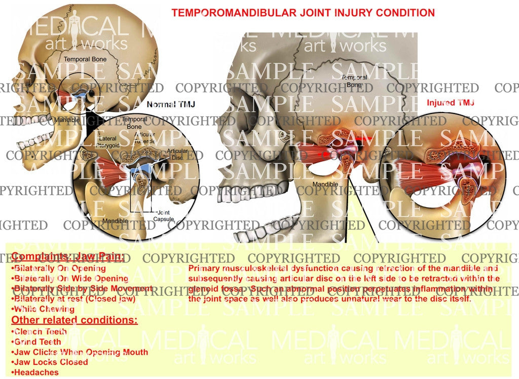 retraction of mandible