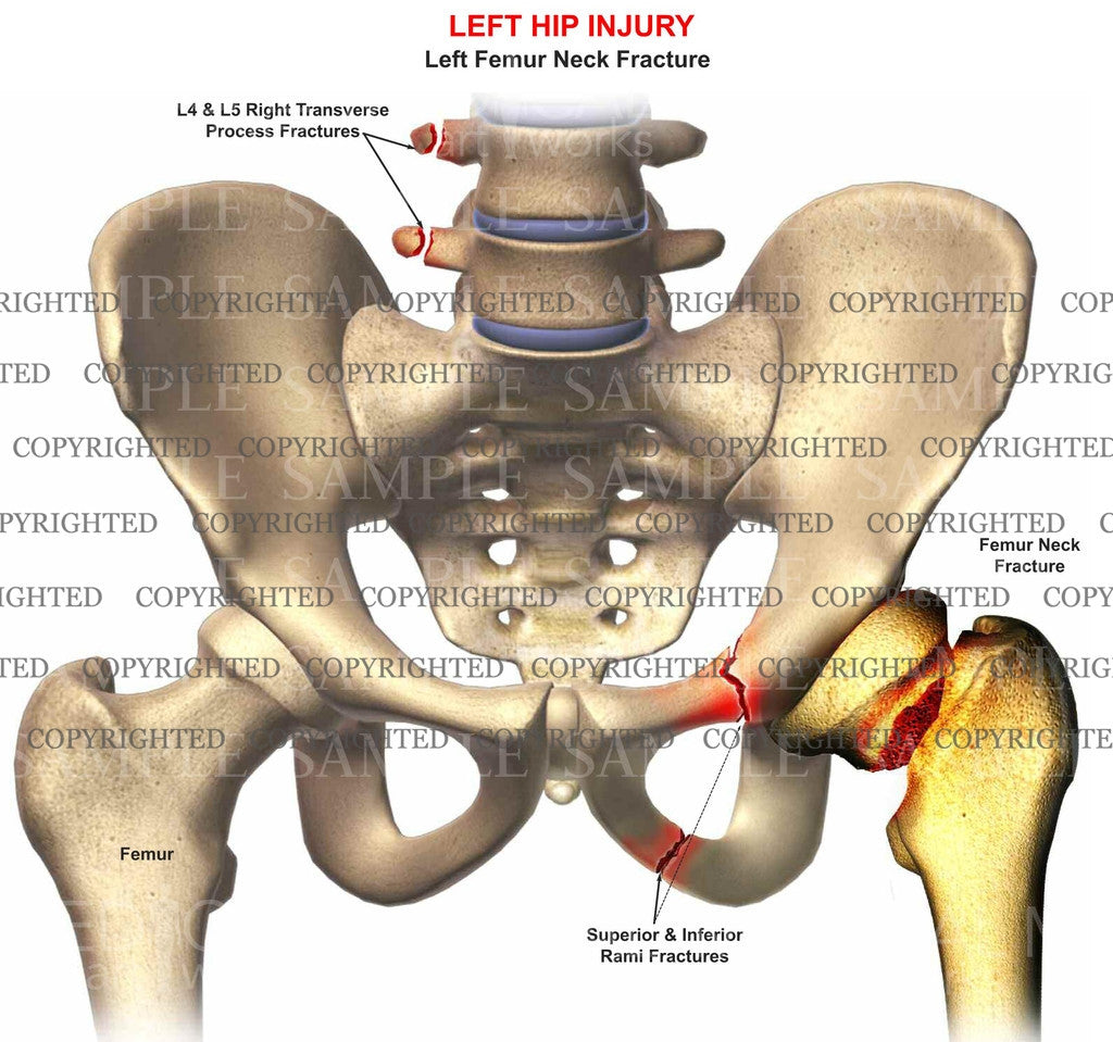Left femur neck, rami fractures – Medical Art Works