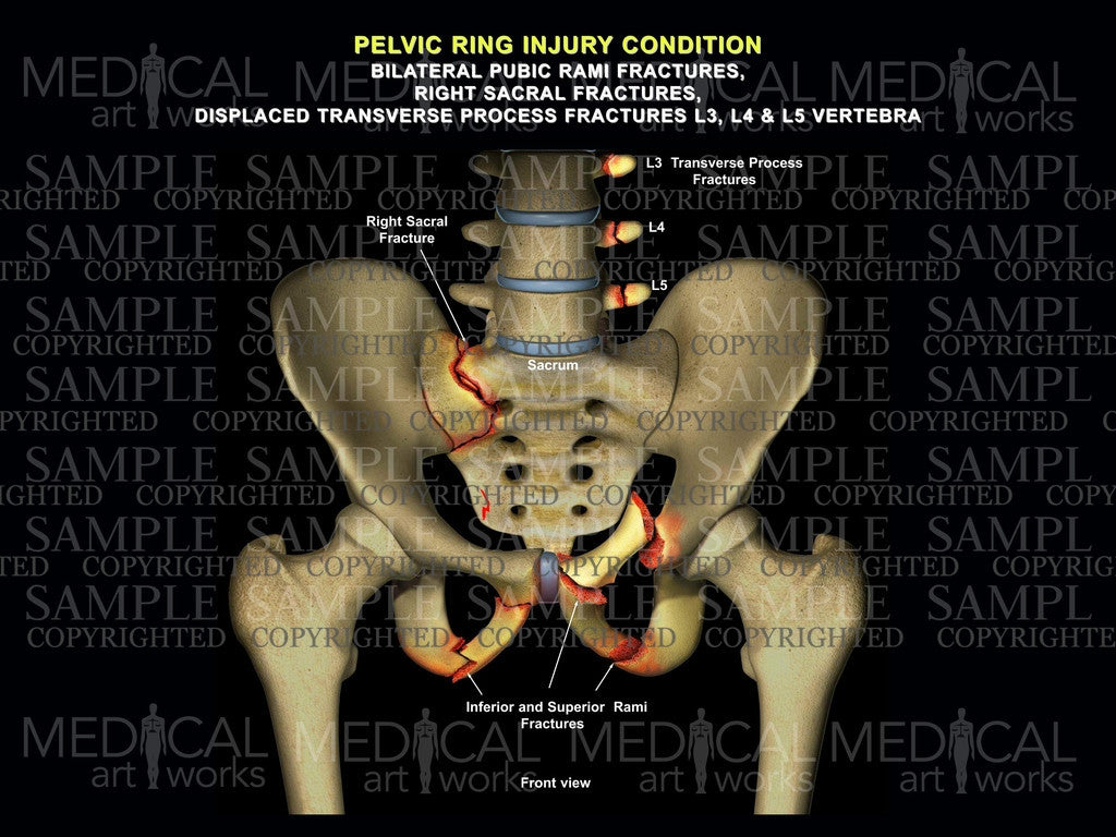 Bilateral hip rami, sacral fractures – Medical Art Works