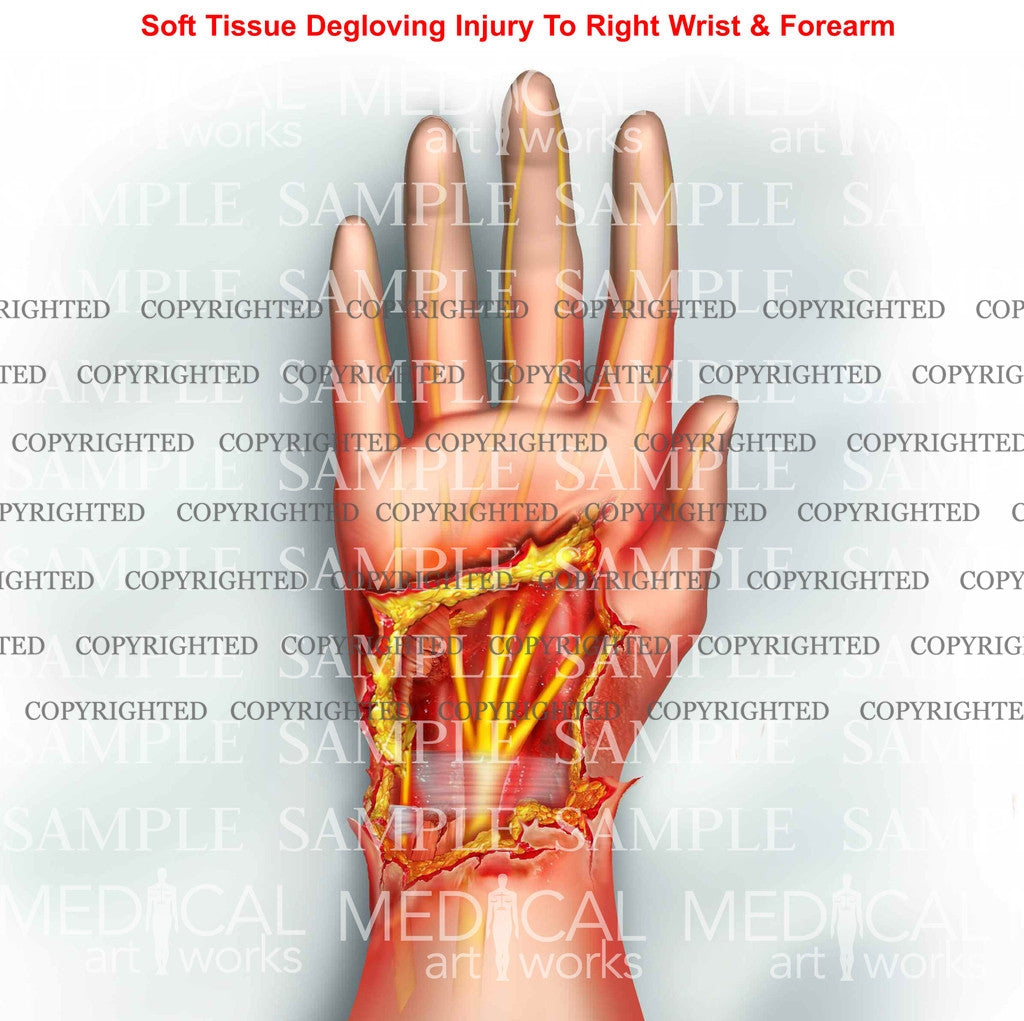 right-hand-degloving-injury-medical-art-works