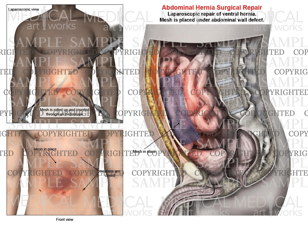 Abdominal ventral hernia mesh repair of a male, front view