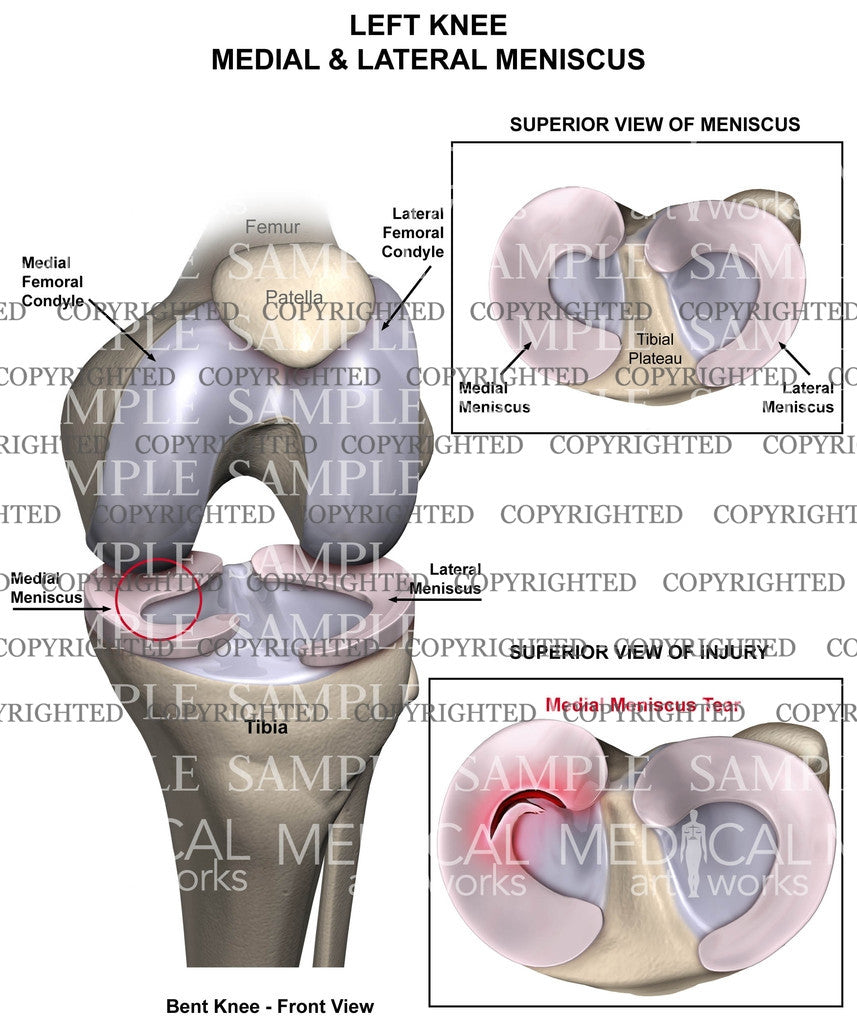 old complex tear of medial meniscus of left knee icd 10