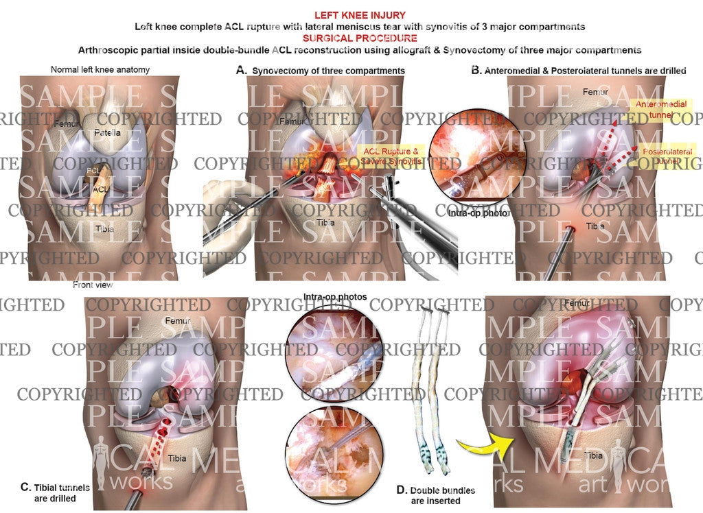 Care Immediately Following ACL Reconstruction – The Nicholas