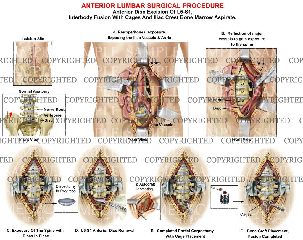 Axial Lumbar Interbody Fusion  Scottsdale, AZ Orthopedic Spine Surgery