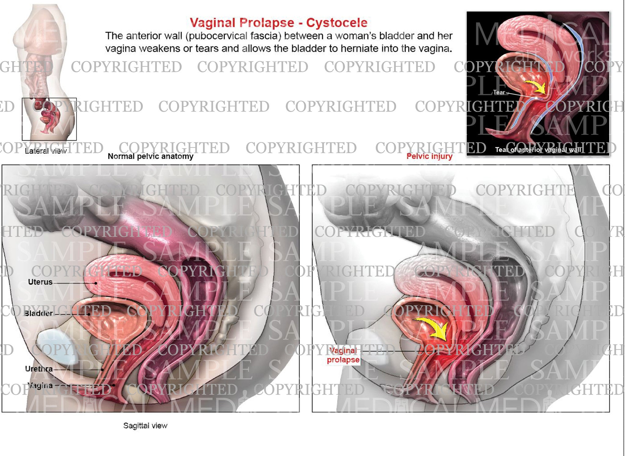 Anterior vaginal prolapse (cystocele) - Diagnosis and treatment - Mayo  Clinic