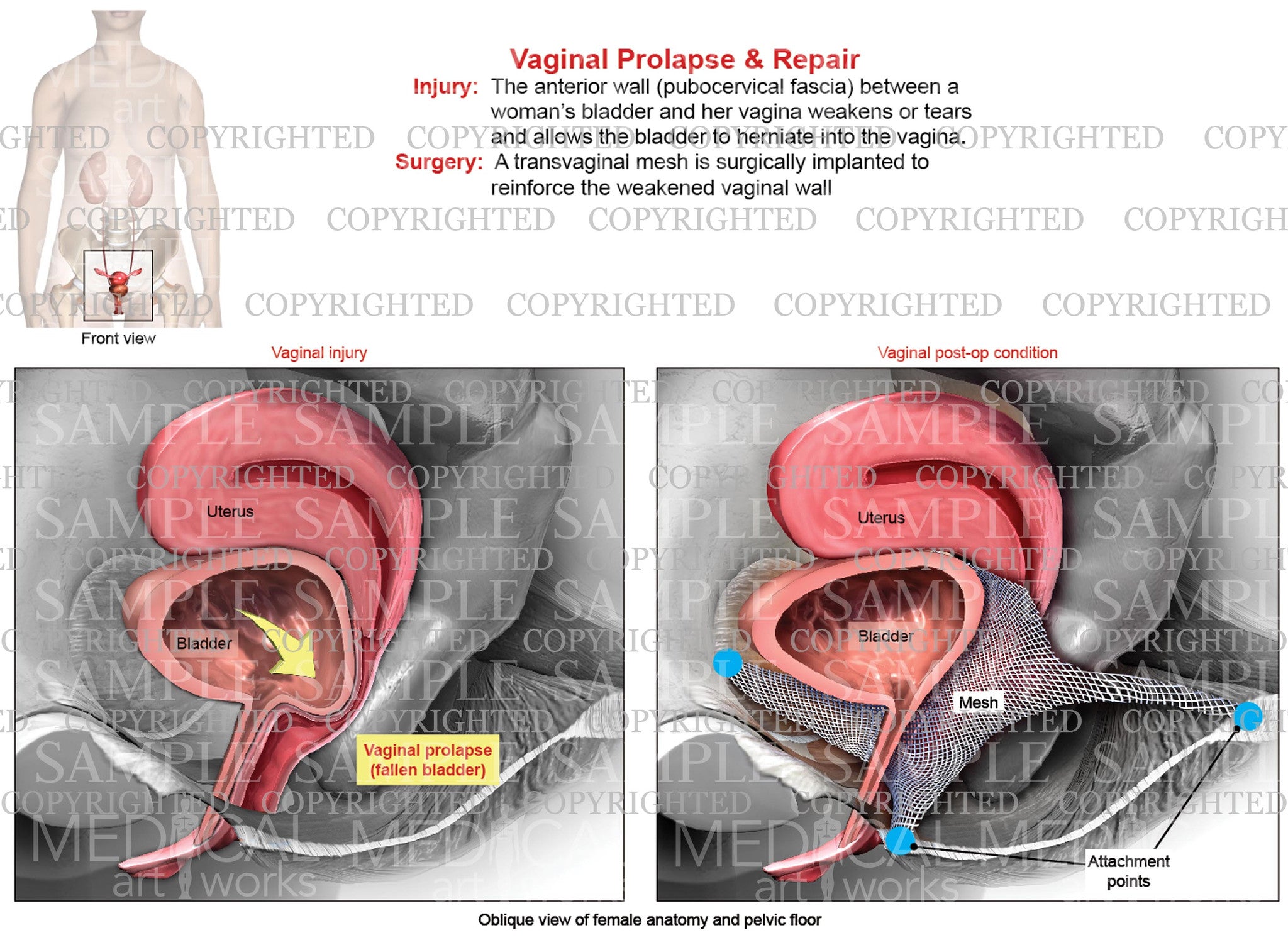 A Cystocele is Also Known As a Bladder Prolapse, a Fallen Bladder, a Prolapsed  Bladder, or an Anterior Vaginal Prolapse Stock Illustration - Illustration  of infection, cancer: 272796958
