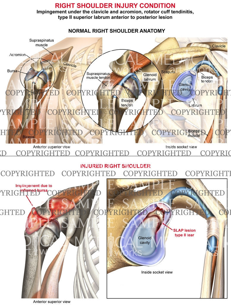 Right Rotator Cuff Tear and Impingement