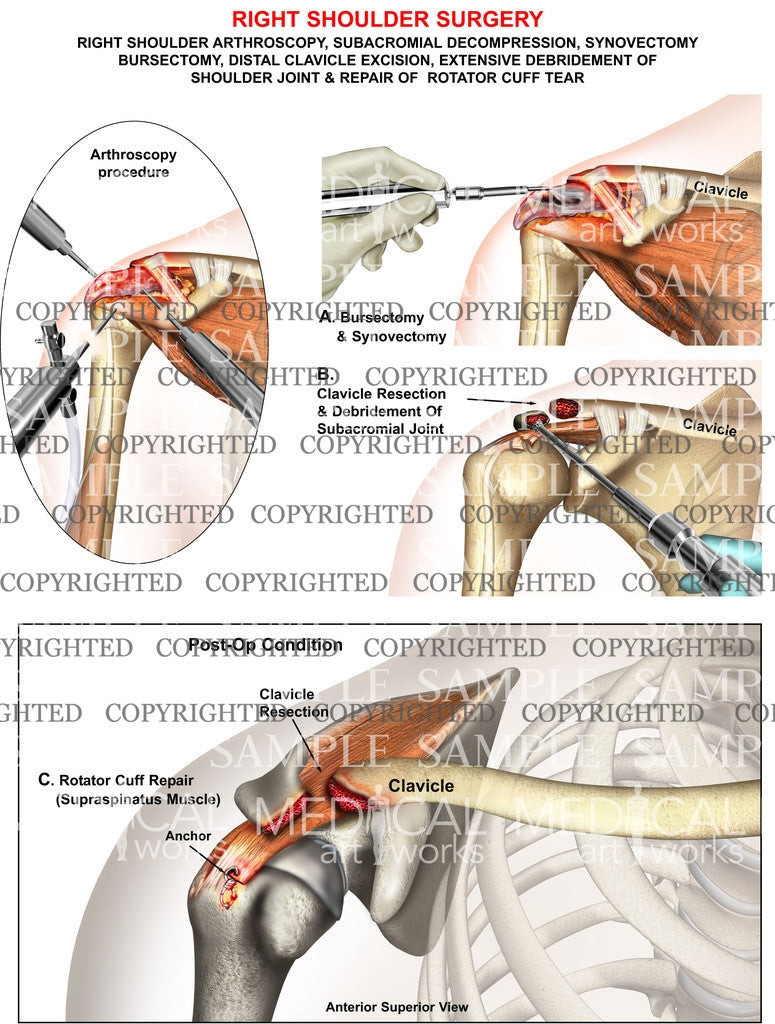 Shoulder arthroscopy: Arthroscopic rotator cuff repair using modified  Arthrex suture-bridge technique Surgical Technique - OrthOracle
