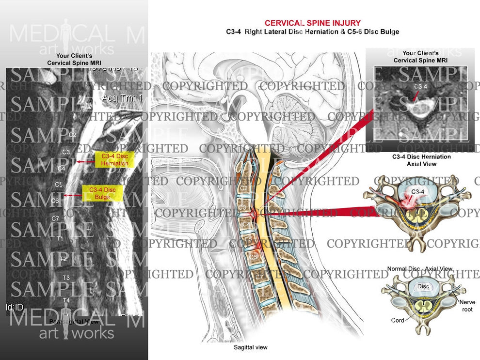 C3 4 Disc Herniation And C5 6 Bulge With Mri Medical Art Works 7390