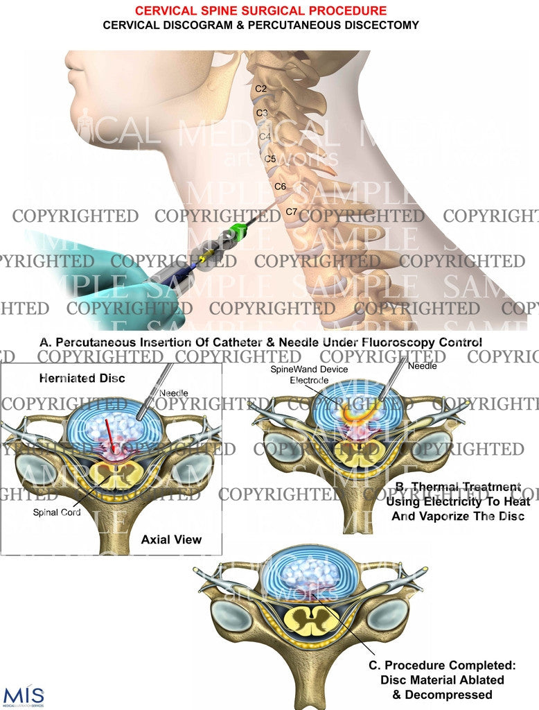 Cervical discogram + percutaneous discectomy – Medical Art Works