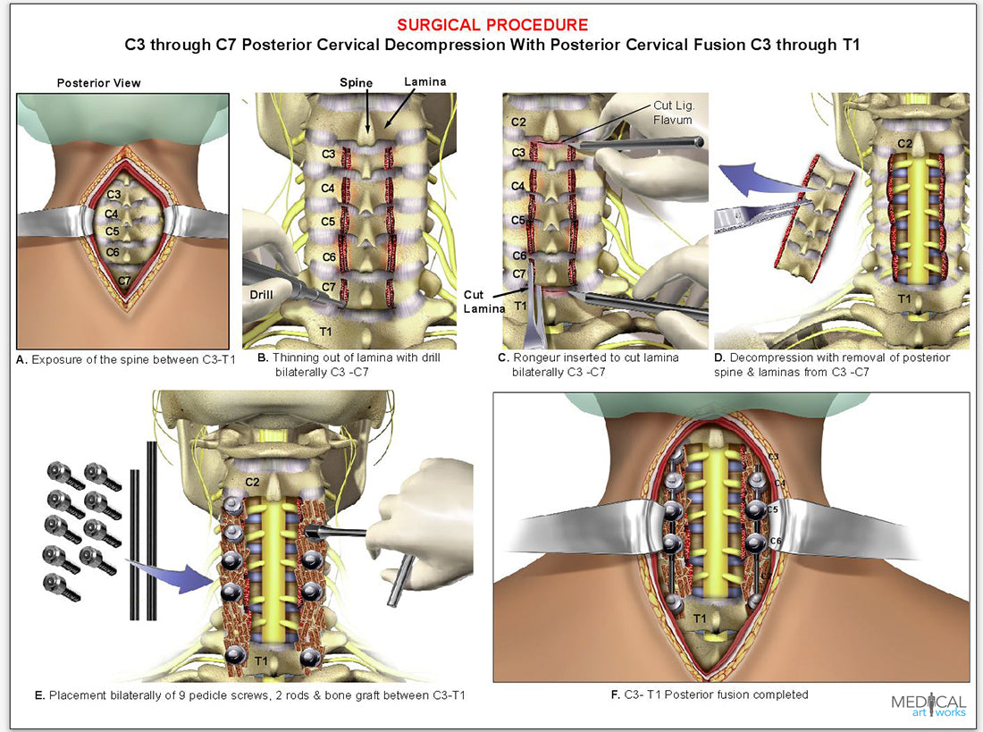 4 level - C3-C7 cervical spine decompression surgical procedure – Medical  Art Works