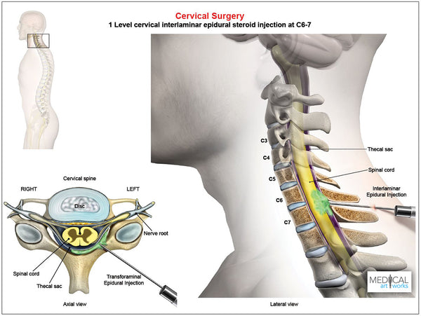 C6-7 Cervical Interlaminar Epidural Steroid Injection - Male – Medical ...