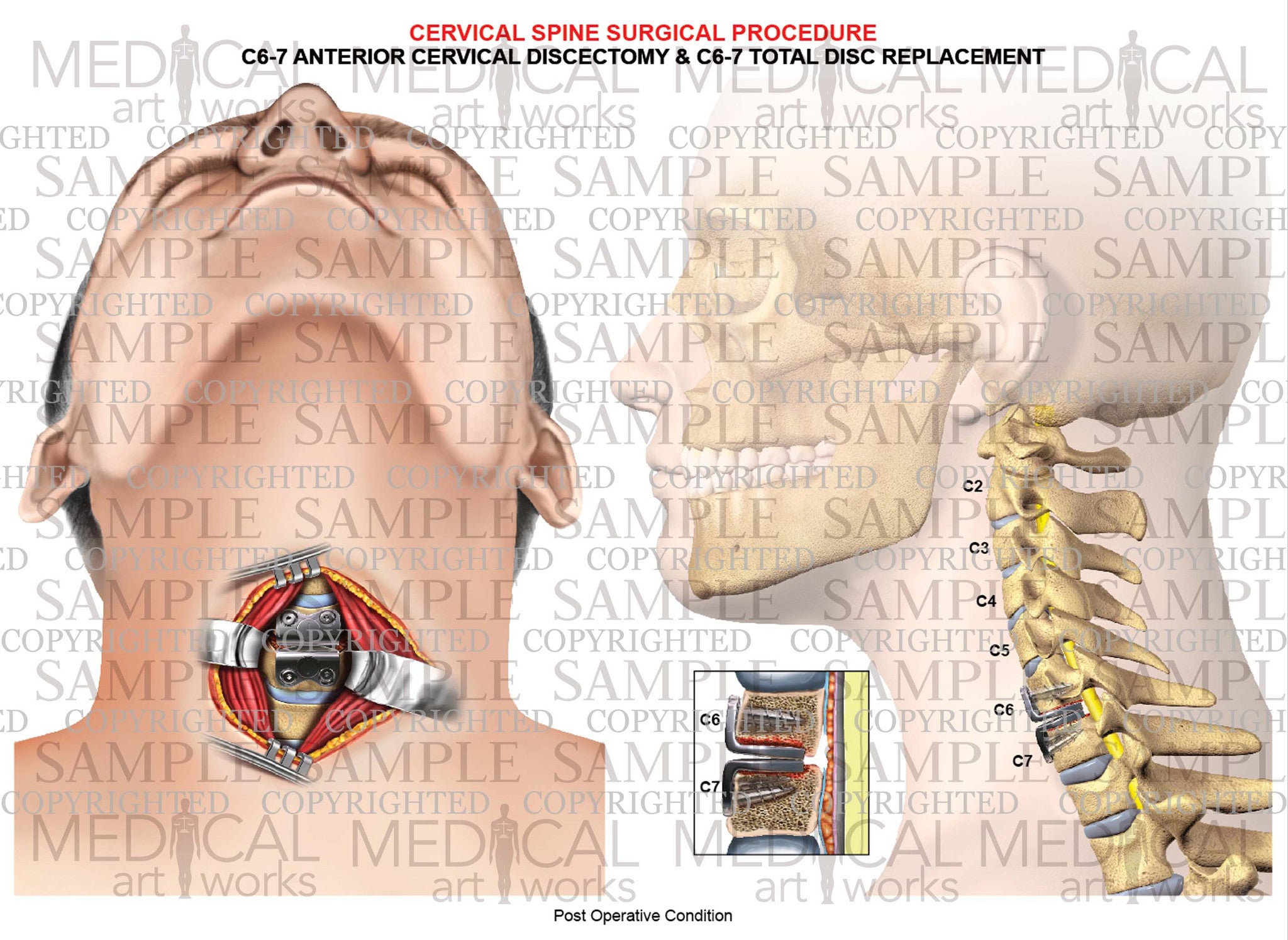 1 Level C6C7 Anterior cervical discectomy and fusion cervical art