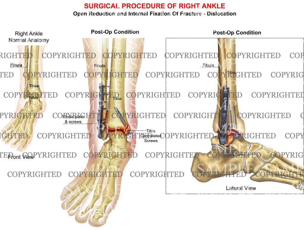 ORIF of bimalleolar tib-fib fracture – Medical Art Works