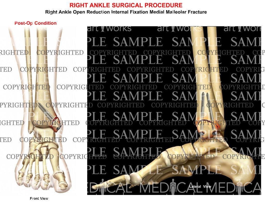 ORIF of medial malleolus tibial fracture – Medical Art Works