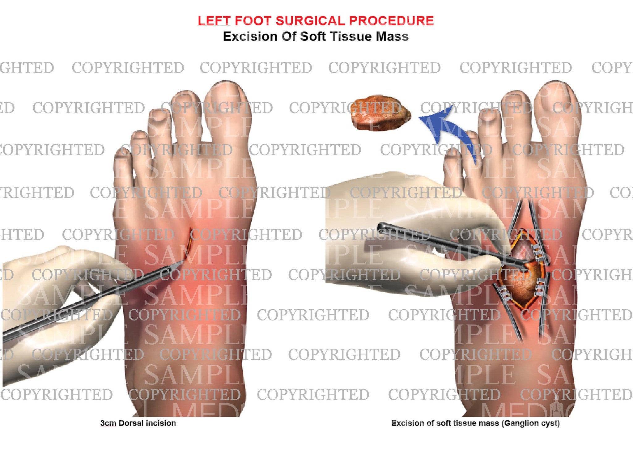 Surgical excision of left foot ganglion cyst – Medical Art Works