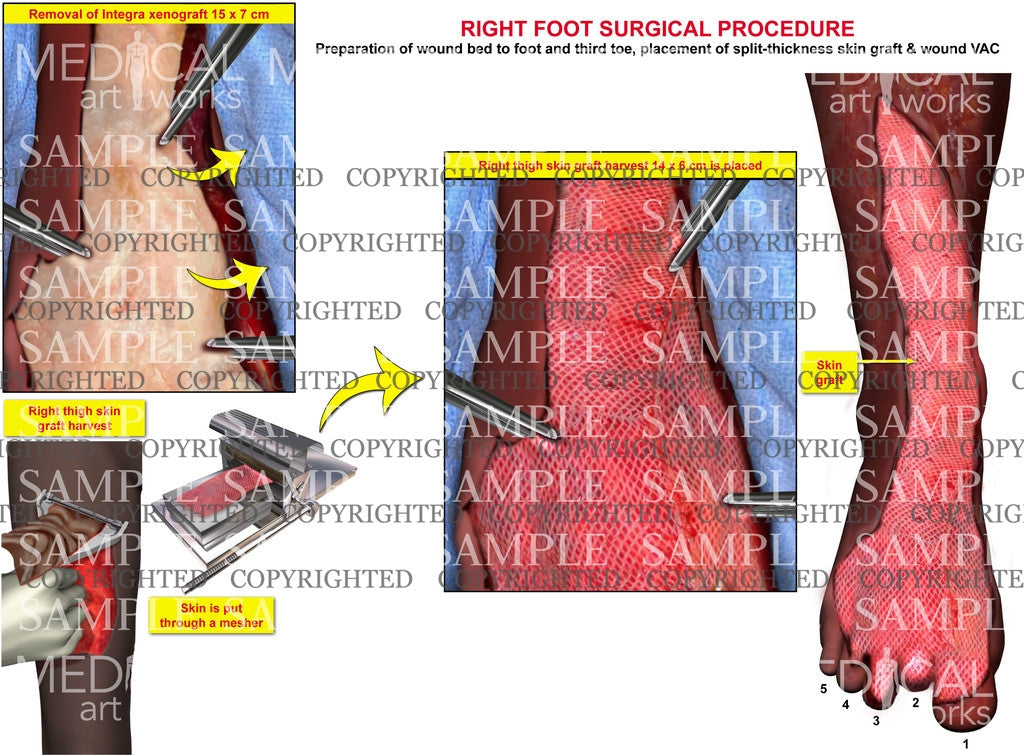 Right foot integra removal and placement of skin graft – Medical Art Works