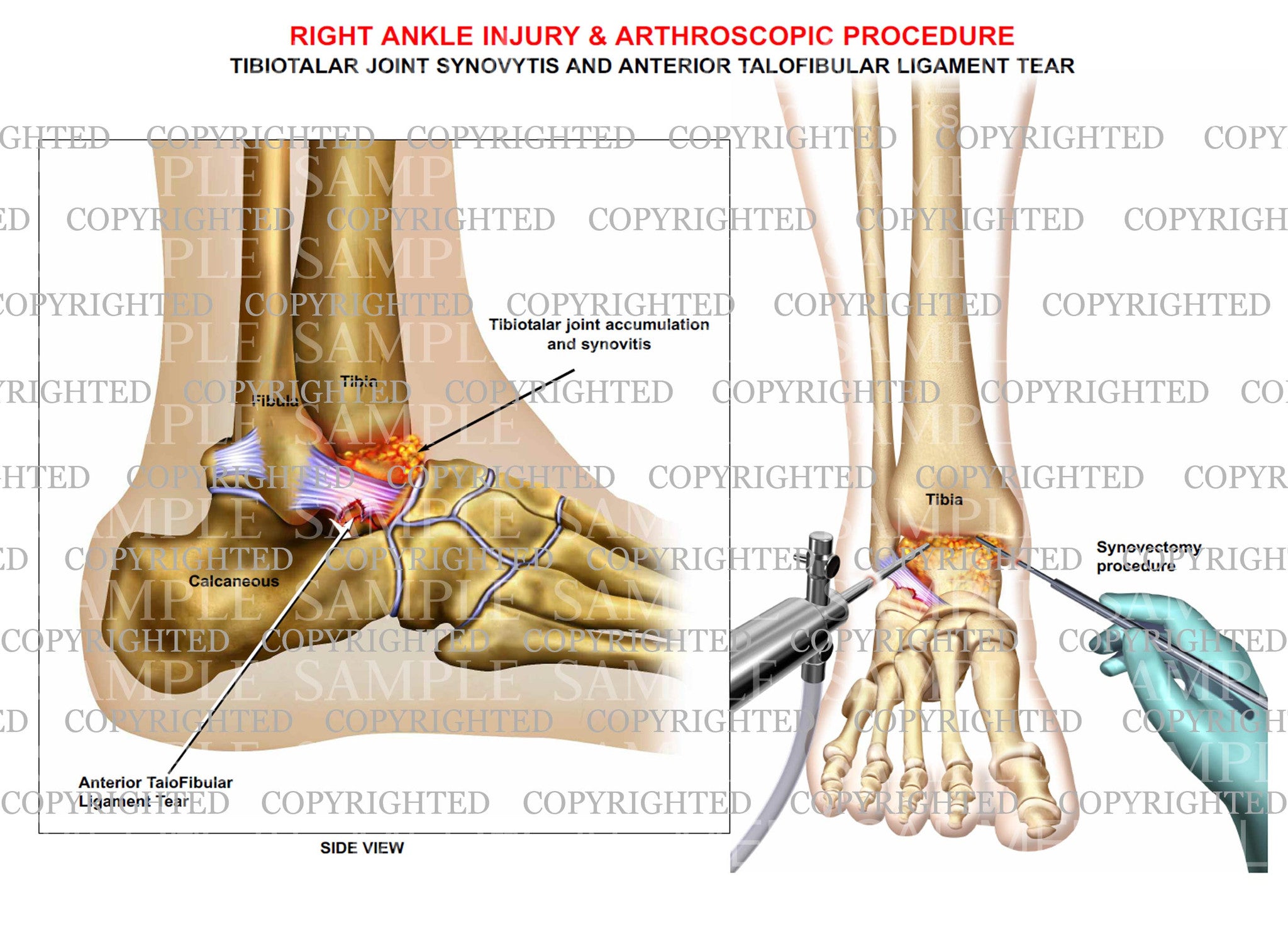 Talofibular ligament tear, joint synovitis & synovectomy – Medical Art ...