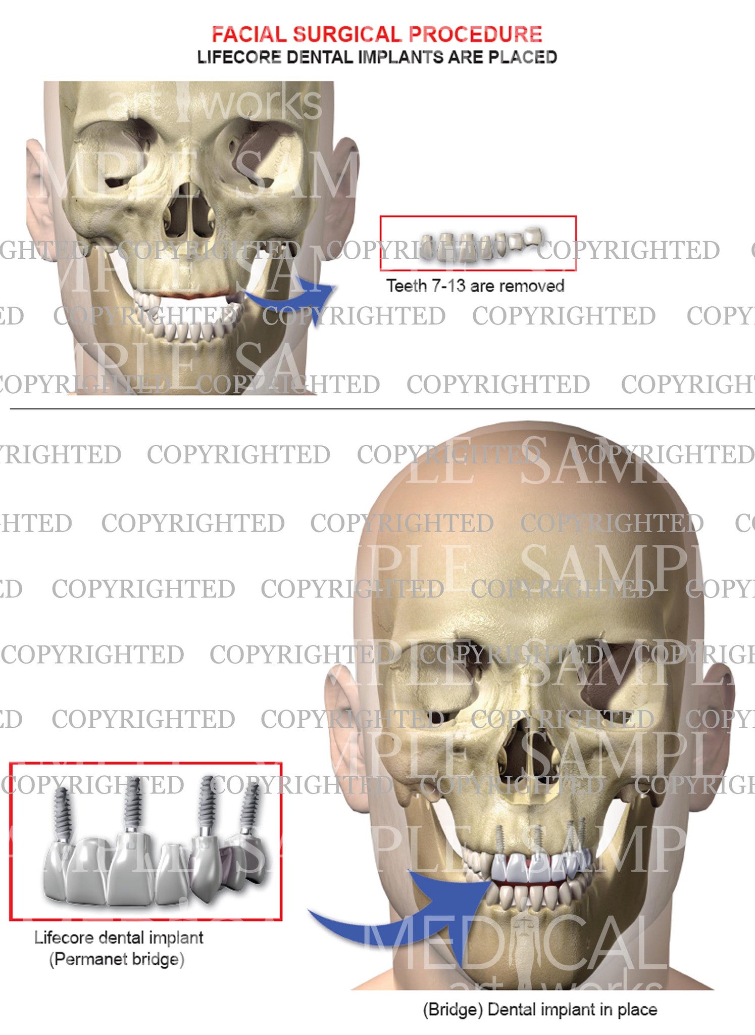 Oral maxilla-facial surgery with lifecore implants – Medical Art Works