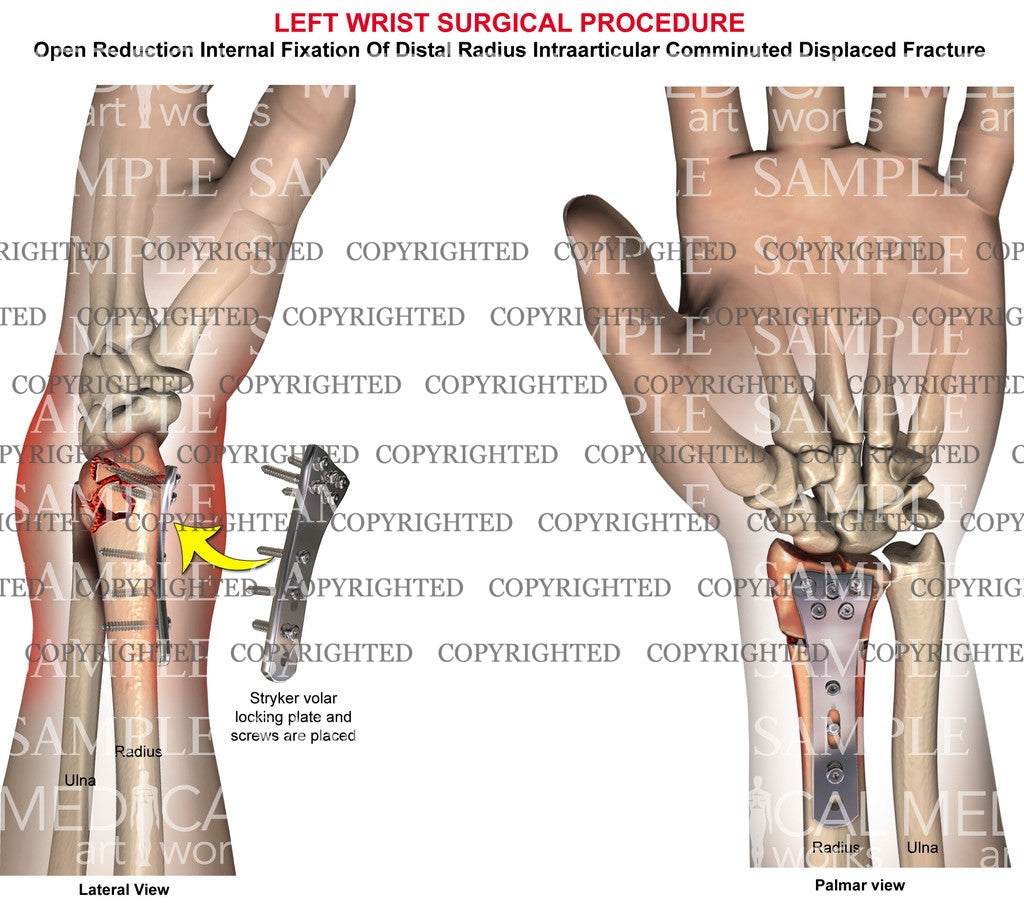 Left radial intraarticular fracture surgery – Medical Art Works