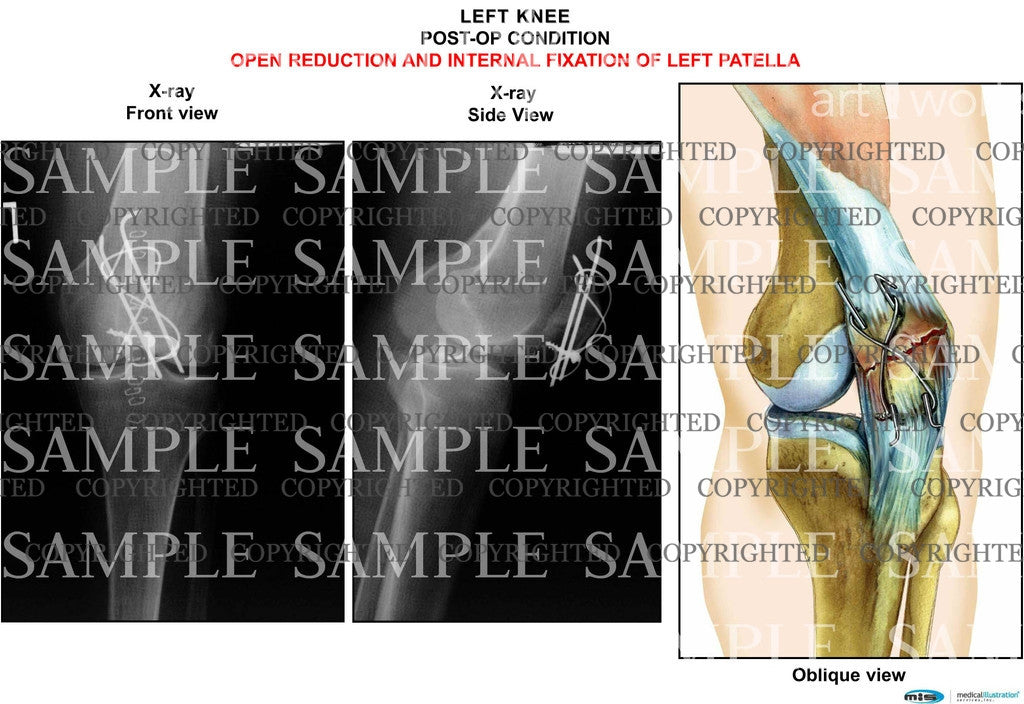 Left sale knee patella