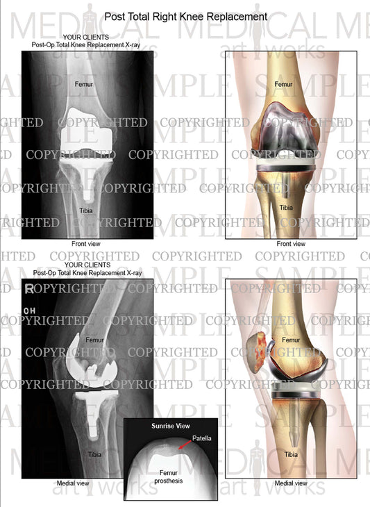 Right knee injury - MCL tear grade 2 - Female