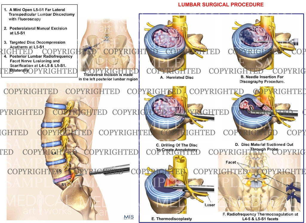 minimal invasive lumbar surgical procdure – Medical Art Works