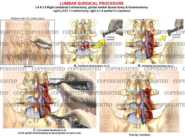 L4 & L5 Right unilateral laminectomy – Medical Art Works