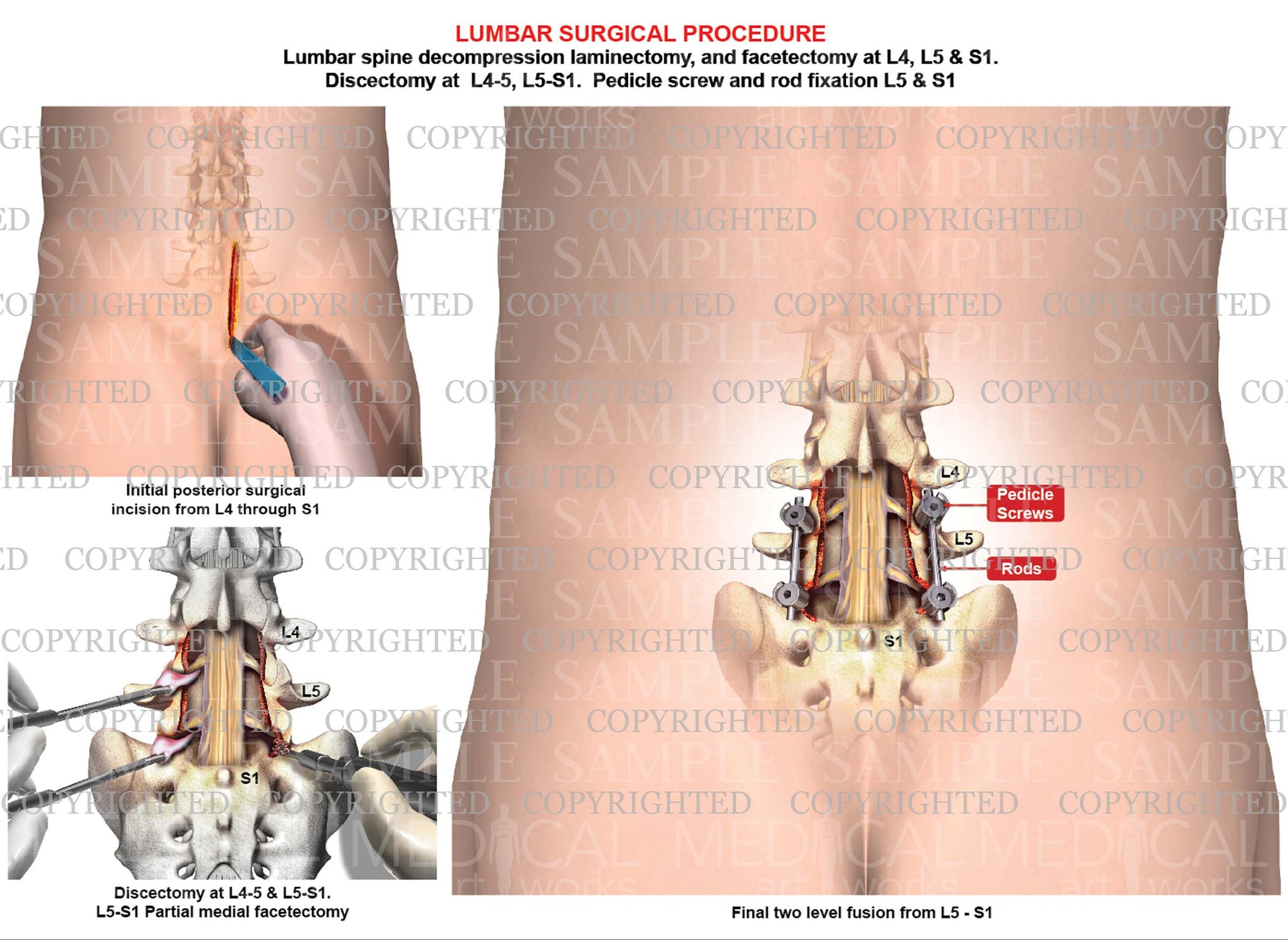 Lumbar Spinal Cord Injury: Understanding L1, L2, L3, L4, L5 SCI