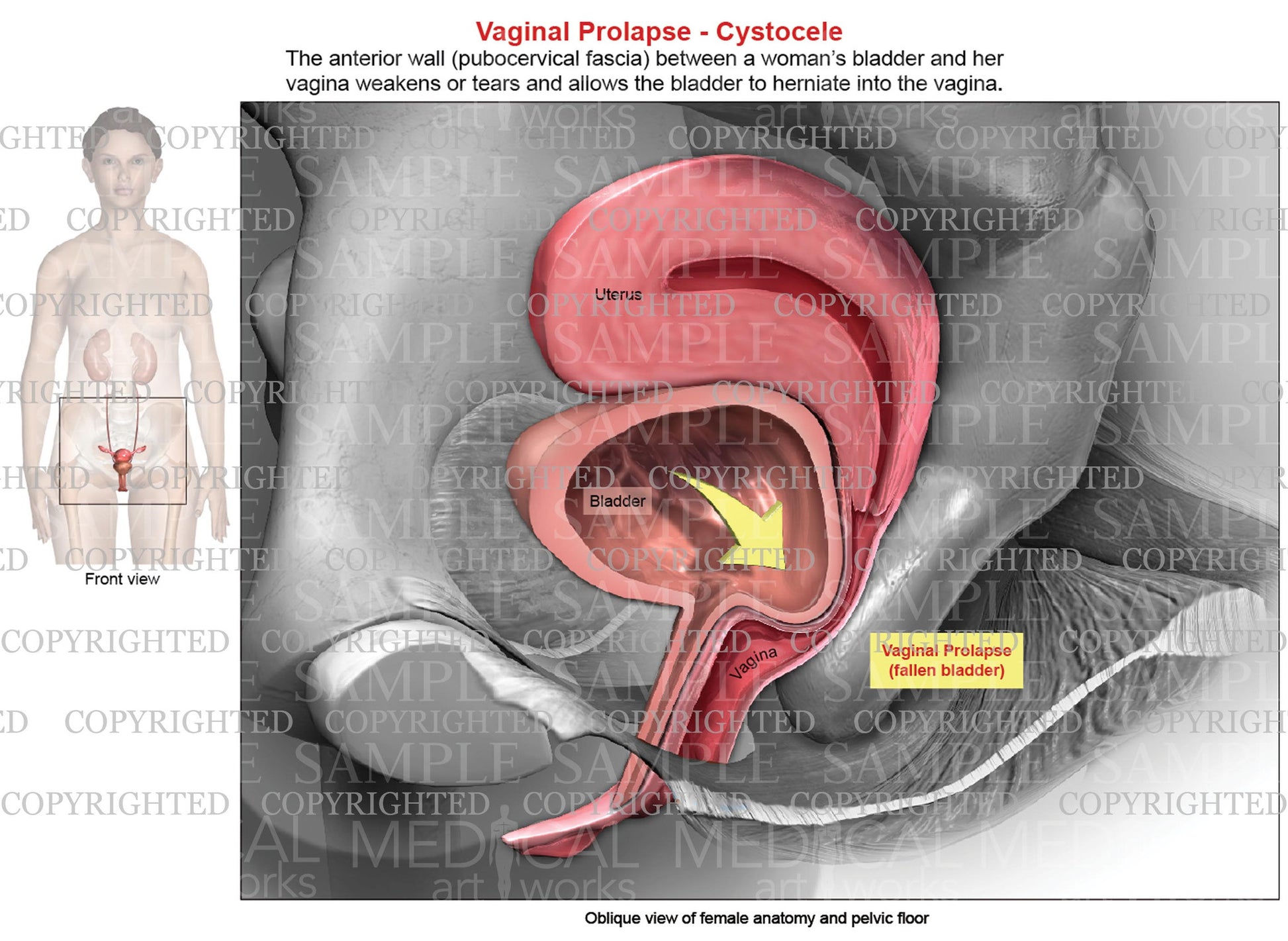 Premium Photo  A cystocele is also known as a bladder prolapse a fallen  bladder a prolapsed bladder or an anterior vaginal prolapse