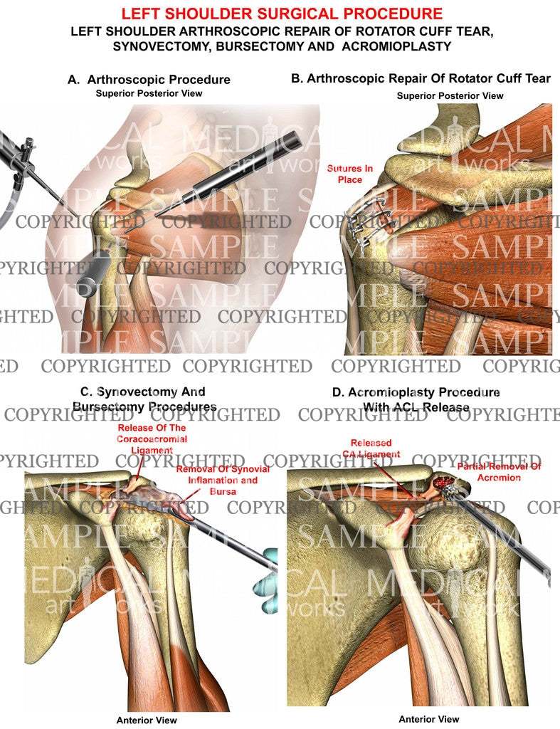 Left Shoulder RC, synovectomy, bursectomy, acromiplasty – Medical Art Works