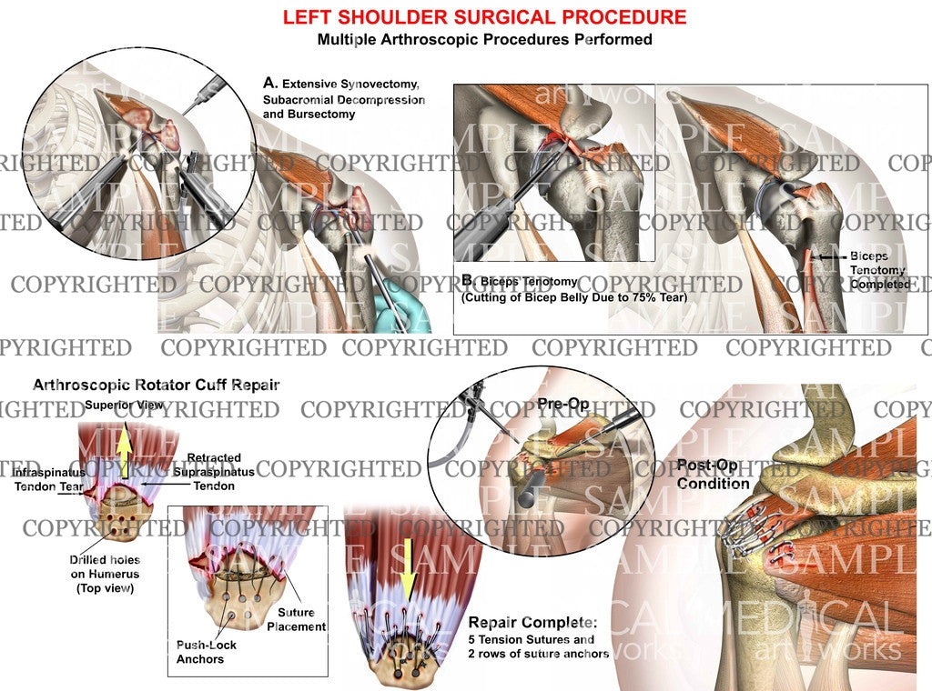 Multiple left shoulder procedures – Medical Art Works