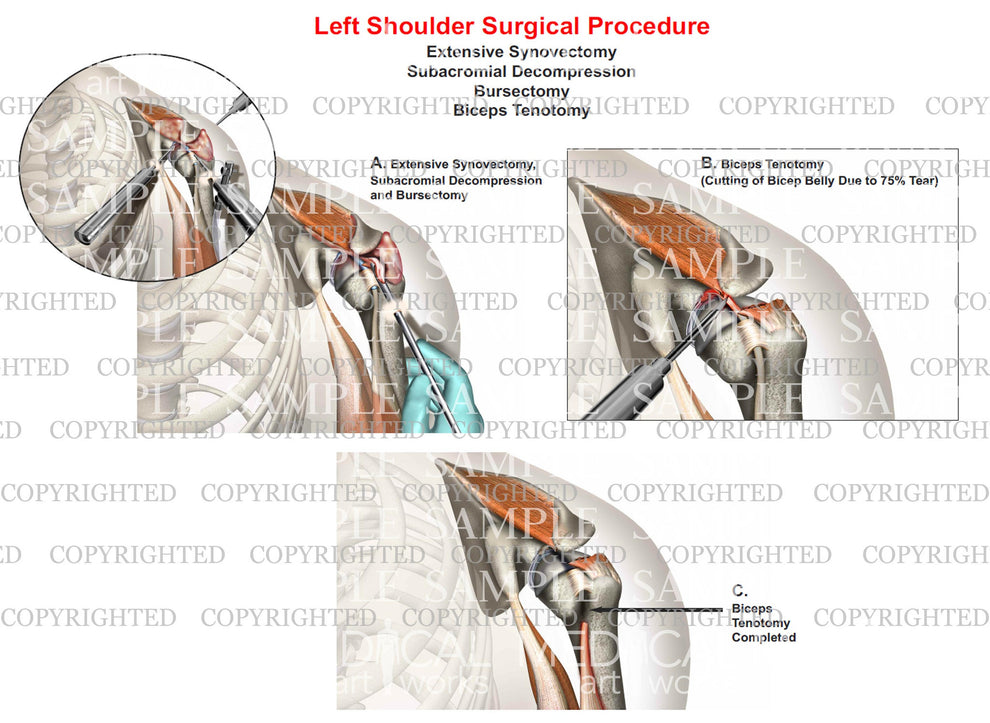 Left shoulder surgery - Synovectomy - Bursectomy - Debridement of RC t ...