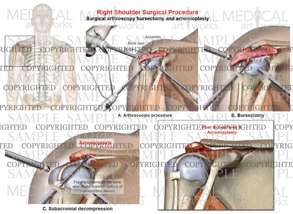 Right arthroscopic surgery bursectomy and acromioplasty – Medical Art Works