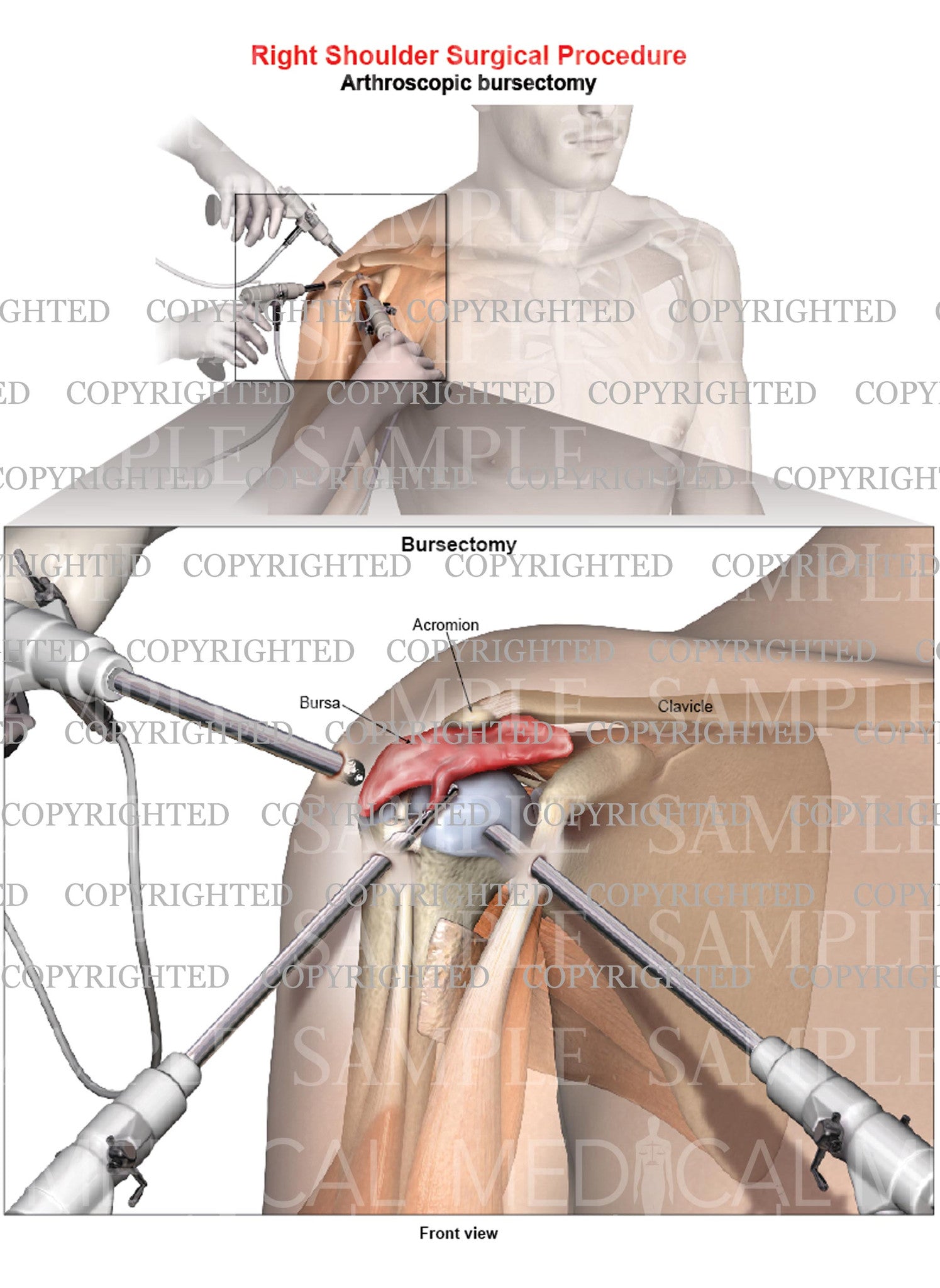 Right shoulder arthroscopic repair - Bursectomy - Male – Medical Art Works